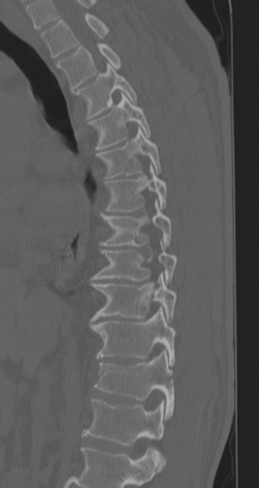 Chance fracture (Radiopaedia 33854-35020 Sagittal bone window 52).png