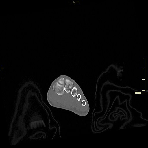 File:Chaput tubercle fracture (Radiopaedia 80319-93956 Coronal non-contrast 5).jpg