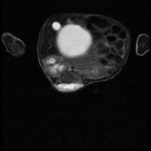 File:Chiari II malformation with spinal meningomyelocele (Radiopaedia 23550-23652 Axial T2 11).jpg