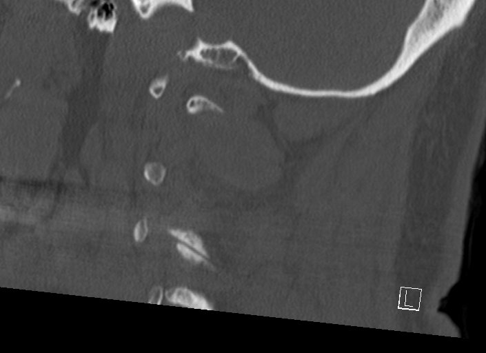 Chiari I malformation with a symptomatic syrinx of the posterolateral medulla oblongata (Radiopaedia 42573-45707 A 16).jpg