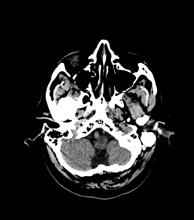 Cholangiocarcinoma with cerebral metastases (Radiopaedia 83519-98628 Axial non-contrast 15).jpg
