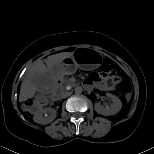 File:Cholecystitis - obstructive choledocholitiasis (CT intravenous cholangiography) (Radiopaedia 43966-47479 Axial 108).png