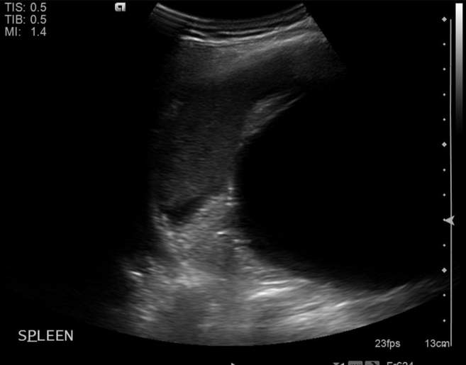 File:Cholecystitis - perforated gallbladder (Radiopaedia 57038-63913 A 18).jpg