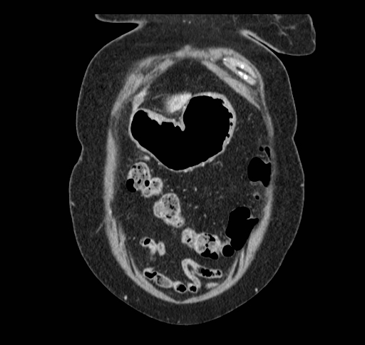 Cholecystoduodenal fistula (Radiopaedia 48959-54022 B 31).jpg