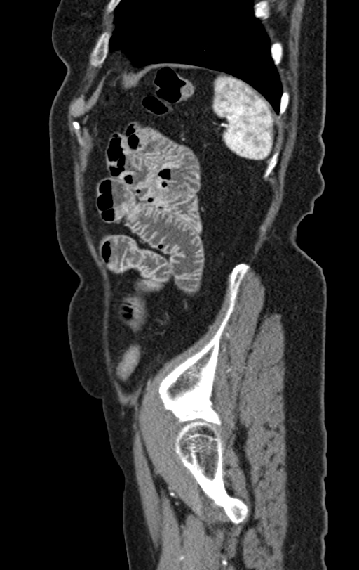 Cholecystoduodenal fistula due to calculous cholecystitis with gallstone migration (Radiopaedia 86875-103077 C 10).jpg