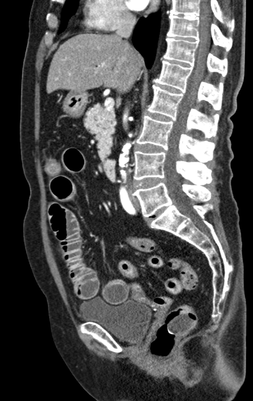 Cholecystoduodenal fistula due to calculous cholecystitis with gallstone migration (Radiopaedia 86875-103077 C 33).jpg