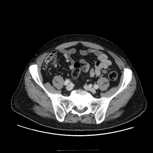 Choledocholiathiasis with normal caliber common bile duct (Radiopaedia 75368-86632 A 142).jpg