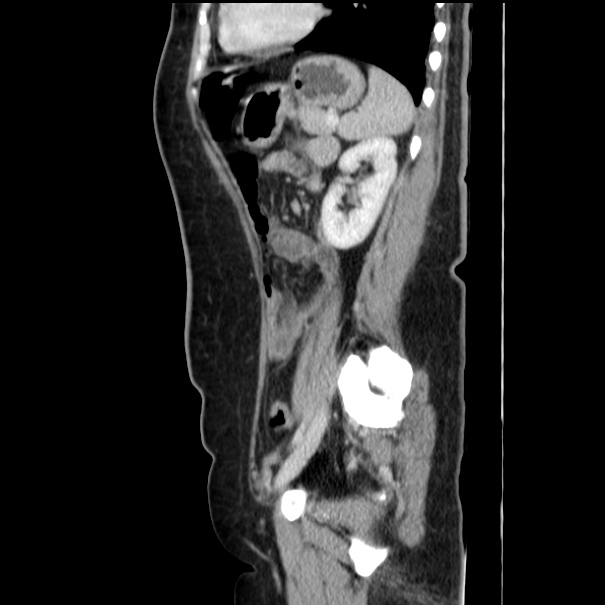 Choledocholithiasis on CT and MRI (Radiopaedia 24825-25087 D 44).jpg