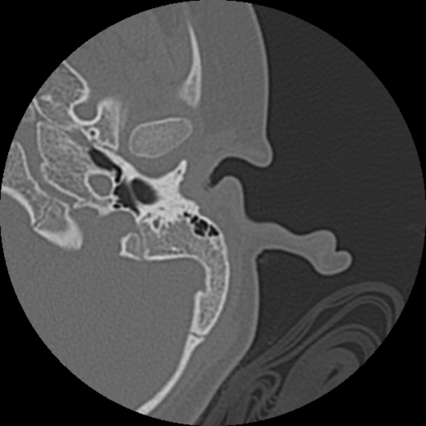 Cholesteatoma (Radiopaedia 73023-83750 Axial Left ear 15).jpg