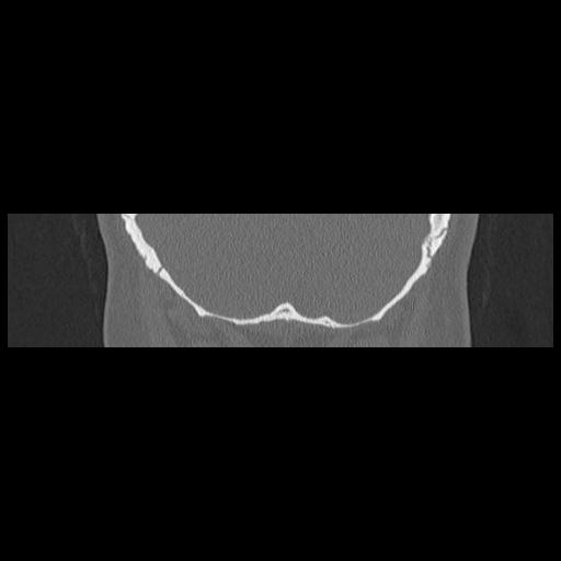 Cholesteatoma (Radiopaedia 84946-100455 Coronal bone window 137).jpg