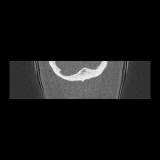 Cholesteatoma (Radiopaedia 84946-100455 Coronal bone window 163).jpg