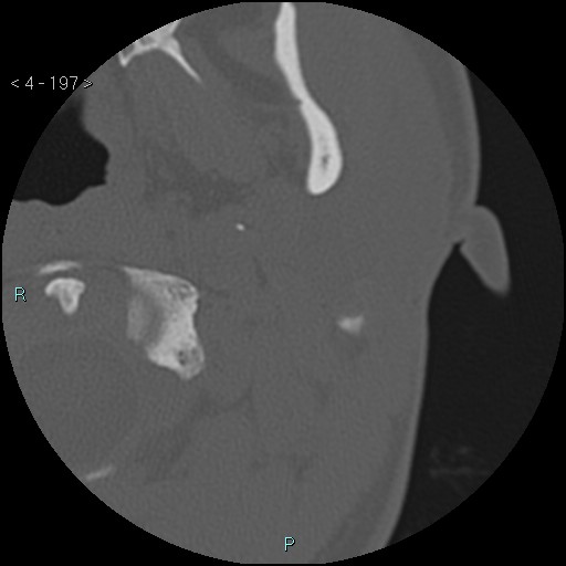 Cholesterol granuloma of the petrous apex (Radiopaedia 64358-73141 Axial bone window 95).jpg