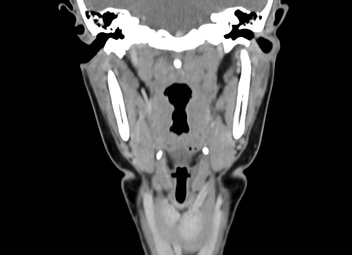 Chondroblastic osteosarcoma (Radiopaedia 67363-76741 D 67).jpg