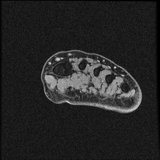 File:Chondroblastoma - midfoot (Radiopaedia 64831-73765 F 27).jpg