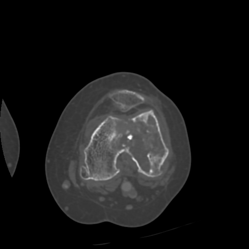 Chondrosarcoma - femur (Radiopaedia 64187-72954 Axial bone window 41).jpg
