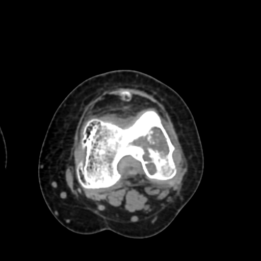 Chondrosarcoma - femur (Radiopaedia 64187-72954 Axial non-contrast 51).jpg