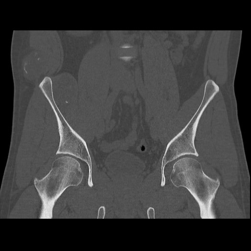 Chondrosarcoma of iliac wing (Radiopaedia 63861-72599 Coronal bone window 56).jpg