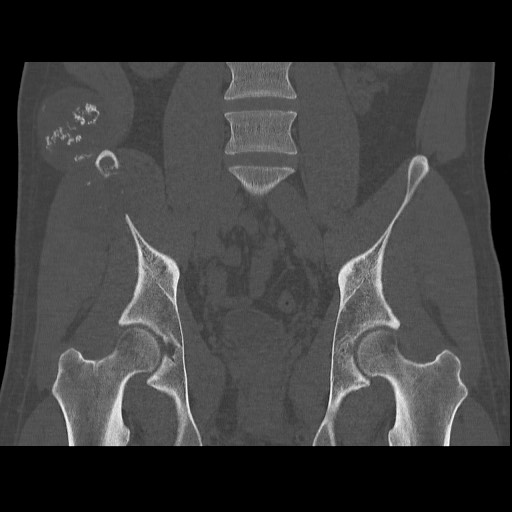 Chondrosarcoma of iliac wing (Radiopaedia 63861-72599 Coronal bone window 63).jpg