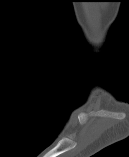 Chopart fracture (Radiopaedia 35347-36851 Sagittal bone window 55).jpg