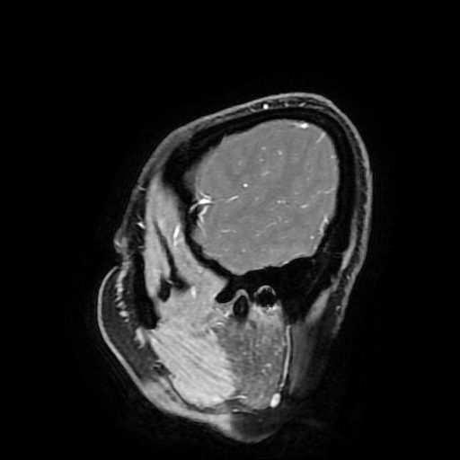 Chordoid glioma of third ventricle (Radiopaedia 91612-109340 F 36).jpg