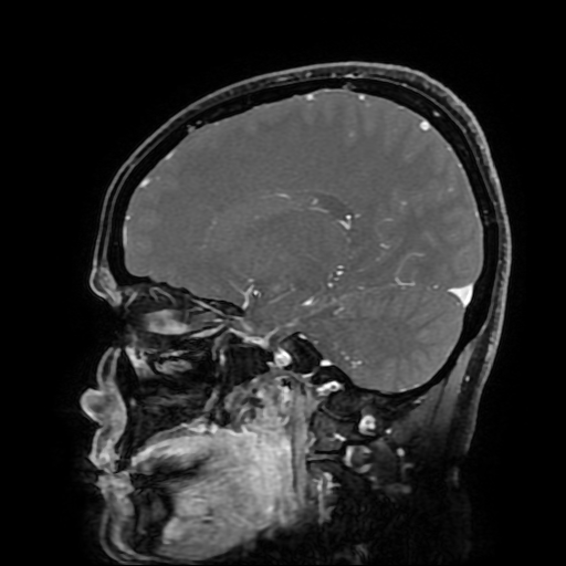 File:Chordoid glioma of third ventricle (Radiopaedia 91612-109340 F 86).jpg