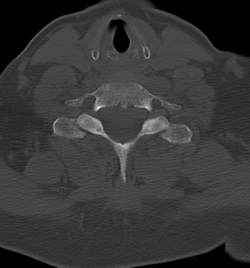 Chordoma (C4 vertebra) (Radiopaedia 47561-52188 Axial bone window 37).png