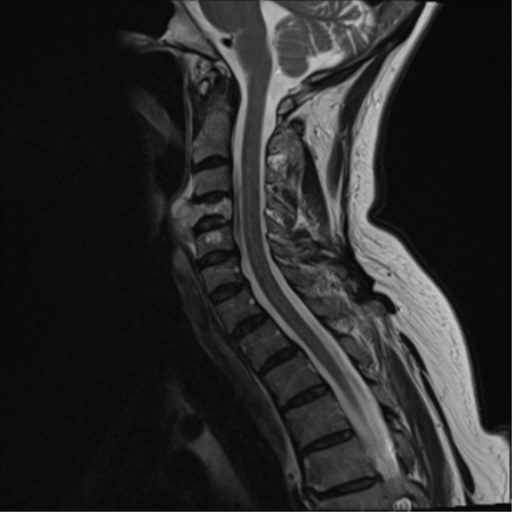 File:Chordoma (C4 vertebra) (Radiopaedia 47561-52189 Sagittal T2 6).png
