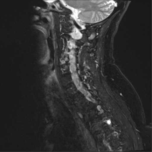 File:Chordoma (C4 vertebra) (Radiopaedia 47561-52189 Sagittal T2 fat sat 3).png