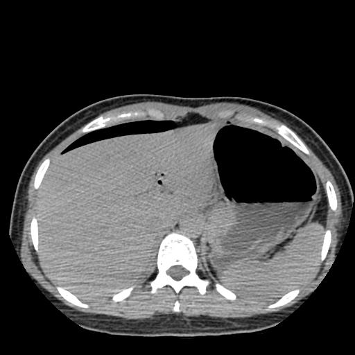 File:Choriocarcinoma of ovary with cerebral and pulmonary metastases (Radiopaedia 25983-26119 Axial non-contrast 60).jpg