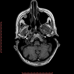 Choroid plexus xanthogranuloma (Radiopaedia 67843-77270 Axial T1 133).jpg