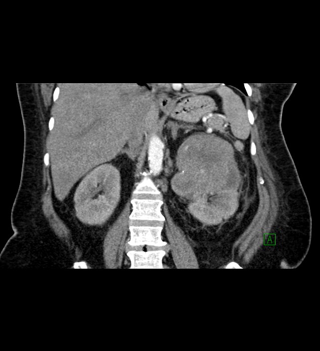 Chromophobe renal cell carcinoma (Radiopaedia 84239-99519 C 55).jpg