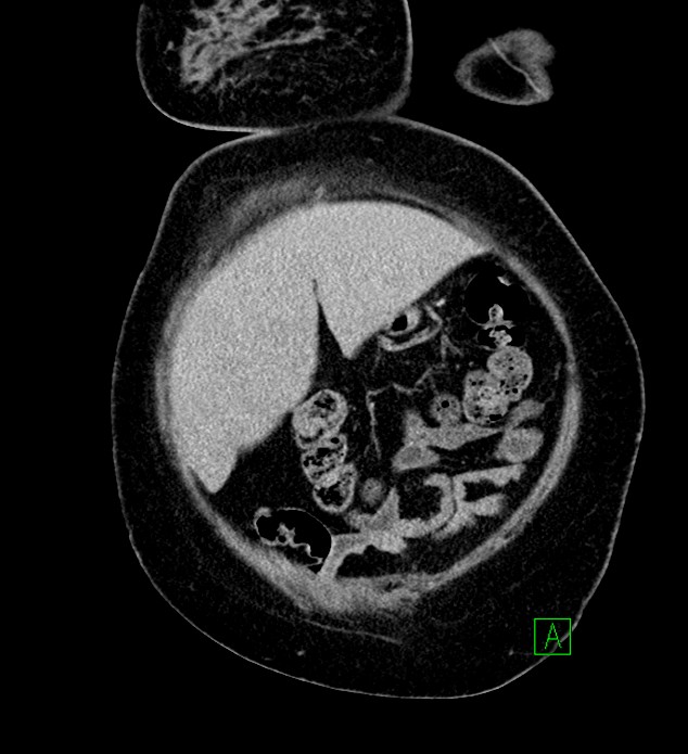 Chromophobe renal cell carcinoma (Radiopaedia 84239-99519 F 16).jpg