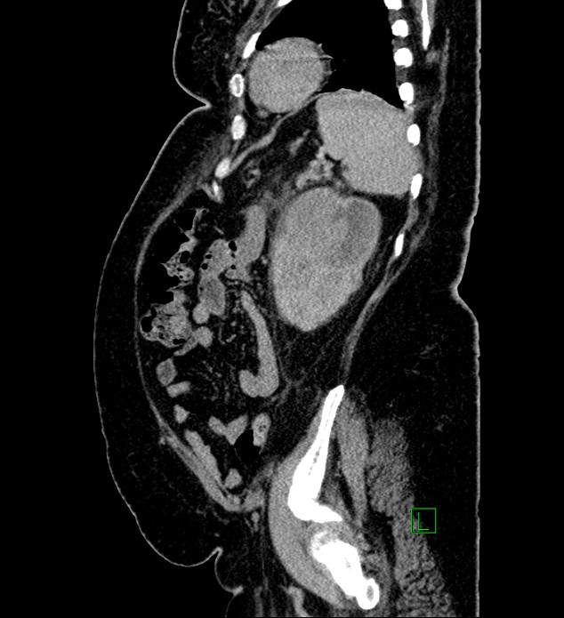 Chromophobe renal cell carcinoma (Radiopaedia 84239-99519 G 29).jpg