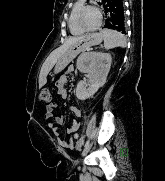 Chromophobe renal cell carcinoma (Radiopaedia 84239-99519 G 42).jpg