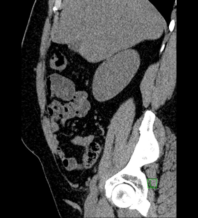Chromophobe renal cell carcinoma (Radiopaedia 84286-99573 C 134).jpg