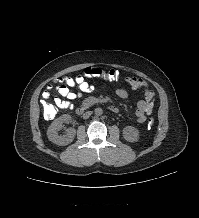 Chromophobe renal cell carcinoma (Radiopaedia 84337-99644 Axial non-contrast 47).jpg