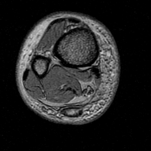 File:Chronic Achilles tendon rupture (Radiopaedia 15262-15100 Axial Gradient Echo 1).jpg