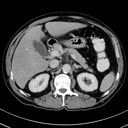 Chronic appendicitis complicated by appendicular abscess, pylephlebitis and liver abscess (Radiopaedia 54483-60700 B 54).jpg