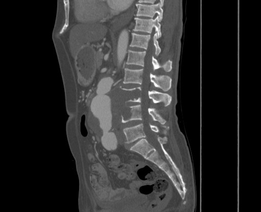 File:Chronic contained rupture of abdominal aortic aneurysm with extensive erosion of the vertebral bodies (Radiopaedia 55450-61901 Sagittal bone window 20).jpg
