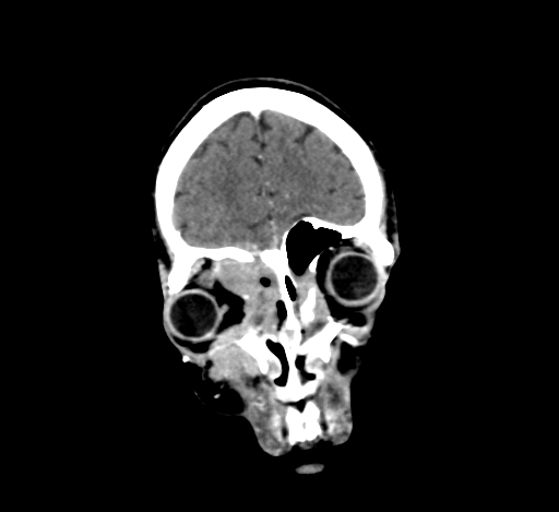 Chronic invasive fungal sinusitis with intraorbital and intracranial extension (Radiopaedia 56387-63046 C 73).jpg
