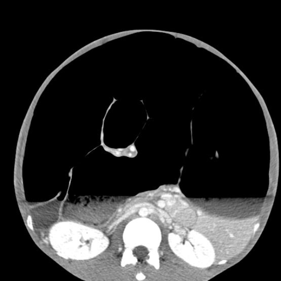 File:Chronic large bowel pseudo-obstruction (Radiopaedia 43181-46492 A 85).jpg