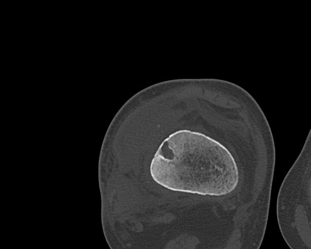 Chronic ostemyelitis of the femur with long sinus tract (Radiopaedia 74947-85982 Axial bone window 200).jpg