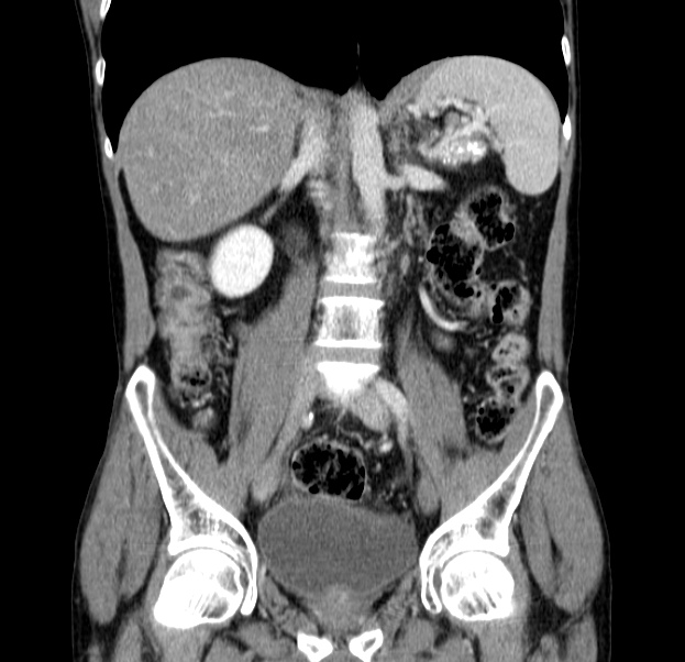 Chronic pancreatitis (Radiopaedia 23132-23172 C 34).jpg