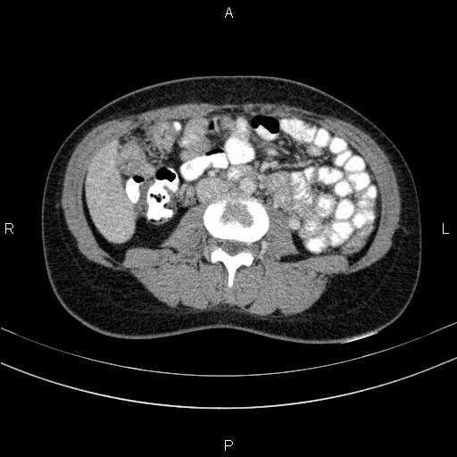 Chronic pancreatitis (Radiopaedia 64576-73450 C 88).jpg
