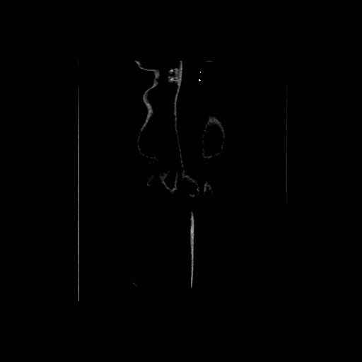 Chronic portal venous thrombosis with cavernous transformation (Radiopaedia 73618-84398 B 99).jpg
