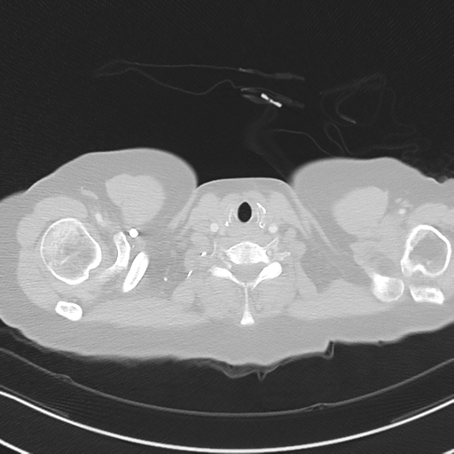 Chronic pulmonary embolus (Radiopaedia 39129-41341 Axial lung window 1).png