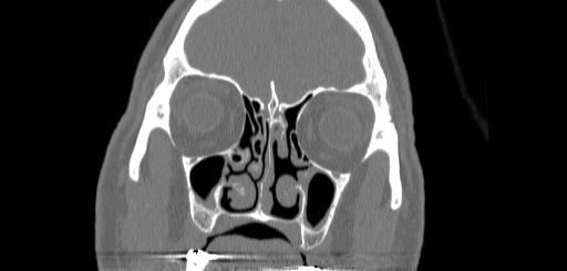 File:Chronic sphenoidal sinusitis (Radiopaedia 62030-70122 Coronal bone window 54).jpg