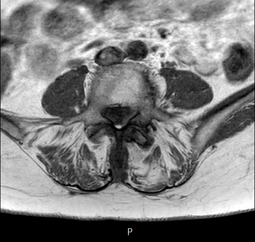 File:Chronic spinal hematoma with cauda equina syndrome (Radiopaedia 75745-87090 Axial T1 22).png