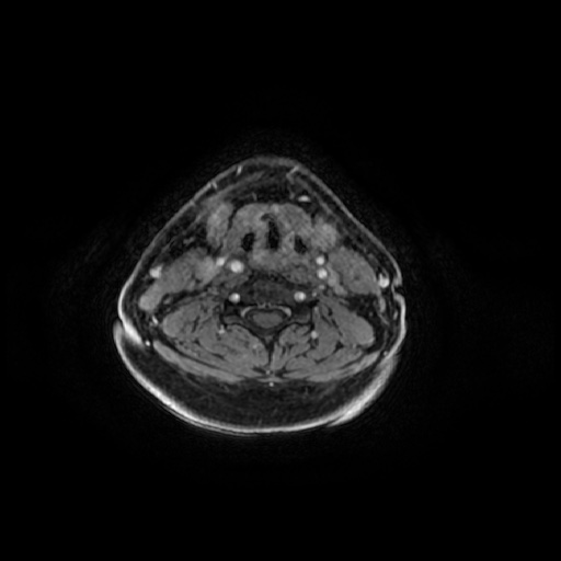 Chronic submandibular sialadenitis (Radiopaedia 61852-69885 Axial T1 C+ fat sat 32).jpg