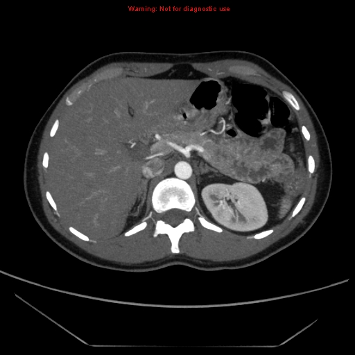 File:Circumaortic left renal vein (Radiopaedia 9069-9792 A 6).jpg
